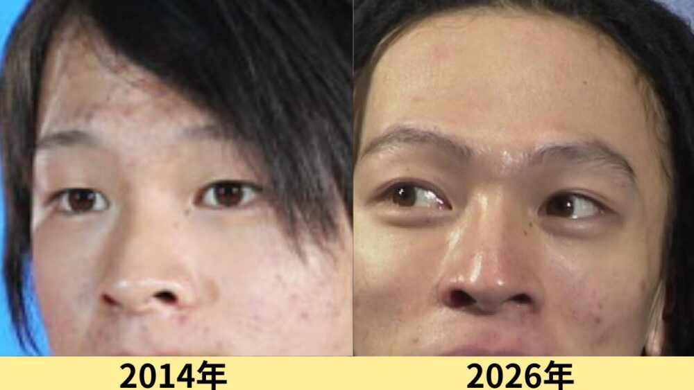 平野歩夢顔変わった