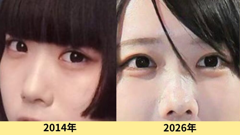 あのちゃん　顔変わった